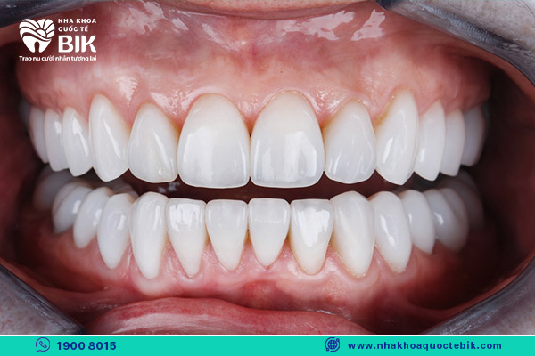 Răng sứ có tác dụng thẩm mỹ như thế nào và có giúp cải thiện nụ cười không?