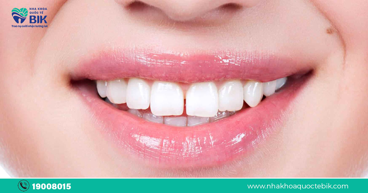 Liệu việc điều trị răng cửa thưa có thể giữ vững kết quả lâu dài không?