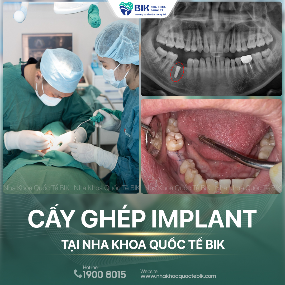 Nha khoa Quốc tế BIK - Địa chỉ trồng răng implant tốt tại TP.HCM