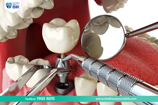 Trồng răng implant cho người mất răng