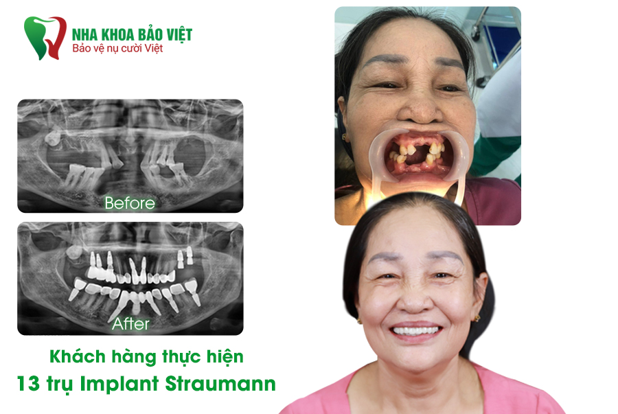 Khách hàng sau khi trồng răng implant