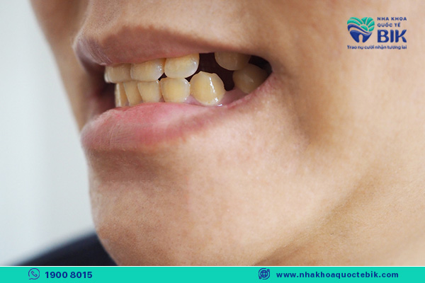 trường hợp nên bọc răng sứ cải thiện tình trạng hô răng