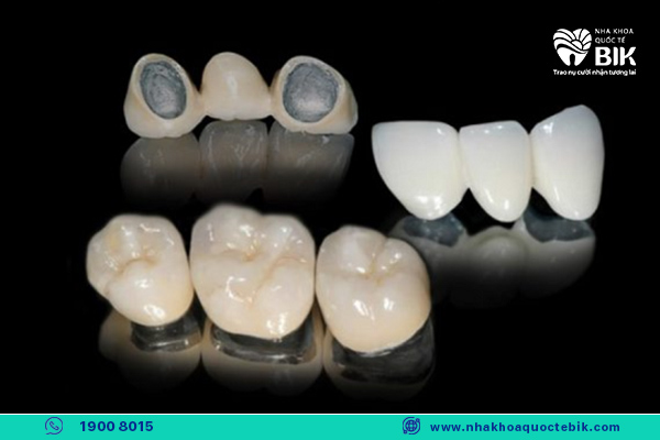 răng sứ kim loại phổ biến hiện nay