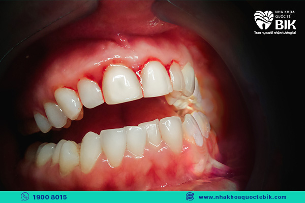 bọc răng sứ kém chất lượng biến chứng viêm nướu răng