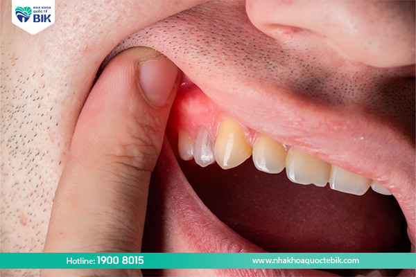 Áp xe răng dẫn đến chảy máu khi đánh răng