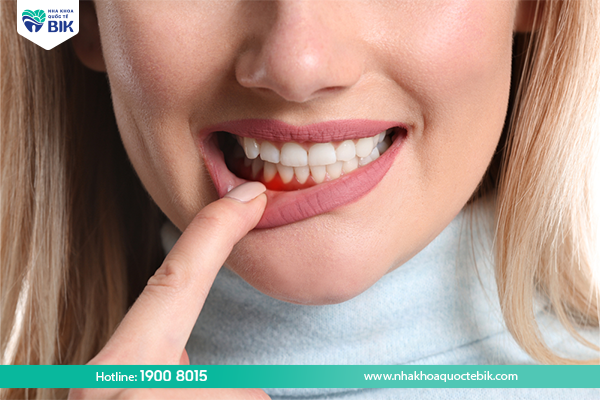 Viêm nha chu gây ra chảy máu khi đánh răng