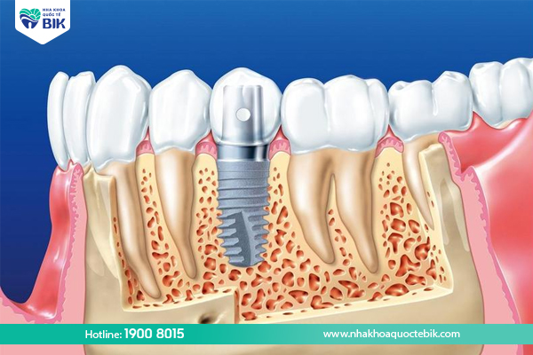 Trồng răng implant khắc phục tiêu xương hàm