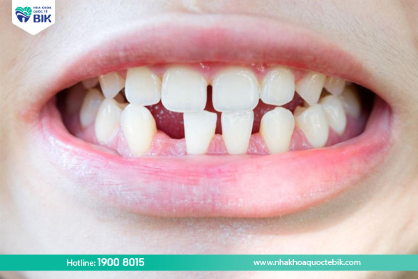 Thiếu răng bẩm sinh là gì?