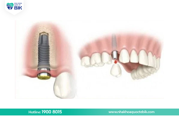 Trồng răng implant khắc phục thiếu răng bẩm sinh