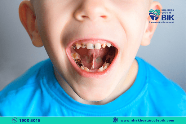 các loại sâu răng thường gặp