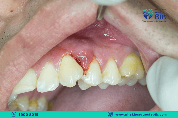 biến chứng nguy hiểm của viêm nướu răng