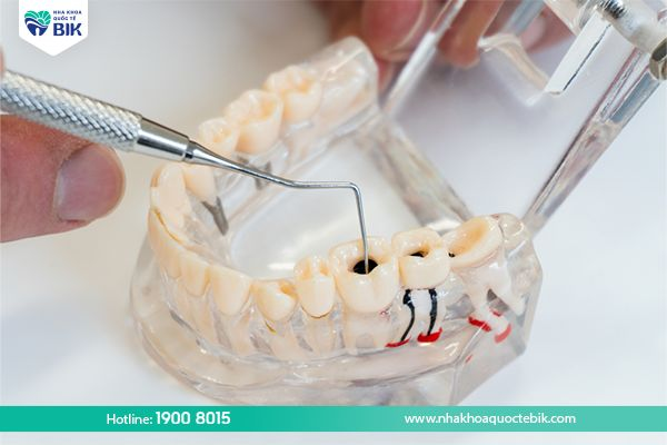 Phương pháp lấy tuỷ răng