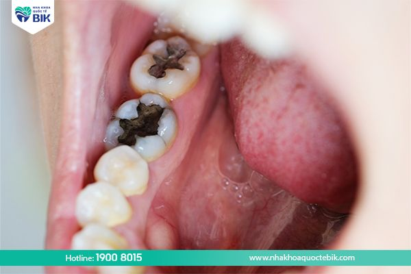 Sâu răng dẫn đến chảy máu chân răng kèm hôi miệng