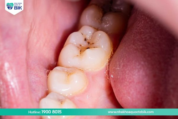 tụt nướu răng làm tăng nguy cơ sâu răng