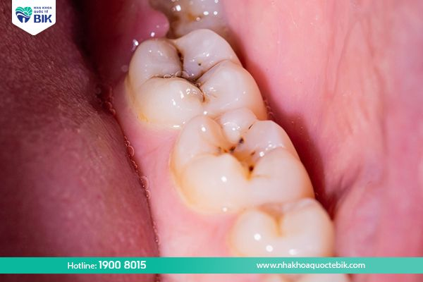Răng sâu gây ra ảnh hưởng nghiêm trọng