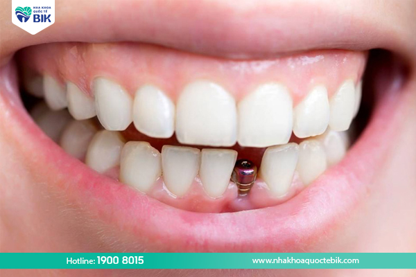 Mất răng vĩnh viễn trồng implant tốt không?