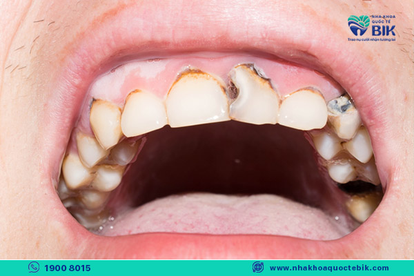 sâu răng là nguyên nhân e buốt răng