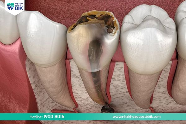 Sâu răng dẫn đến viêm tuỷ, vỡ răng