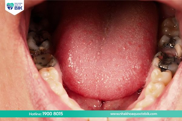 Vì sao lỗ sâu răng gây mùi hôi