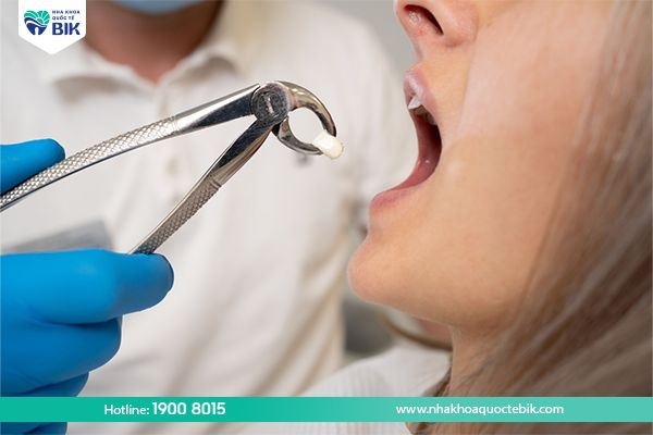 Nhổ răng cấm bị sâu nặng có nguy hiểm không