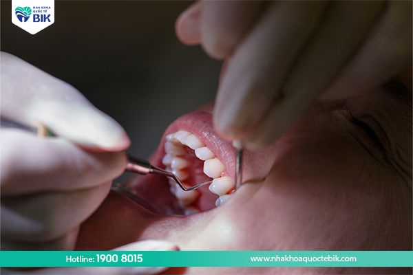 Lấy cao răng điều trị viêm nha chu
