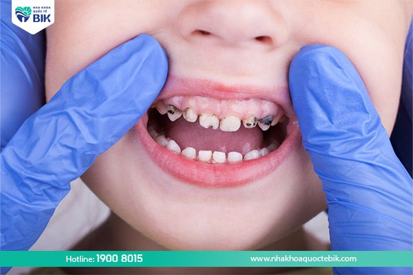 Răng bị sâu ảnh hưởng đến các răng xung quanh