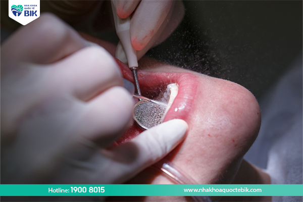 Lấy cao răng để điều trị viêm quanh răng