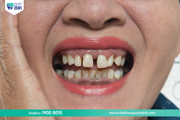 Kết cấu răng xấu gây sâu răng người lớn