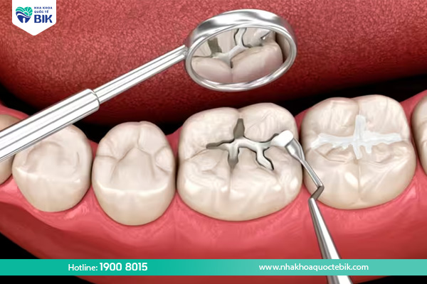 Điều trị sâu răng người lớn bằng cách trám răng