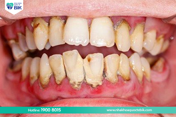 Vệ sinh răng miệng kém gây mất răng hàm