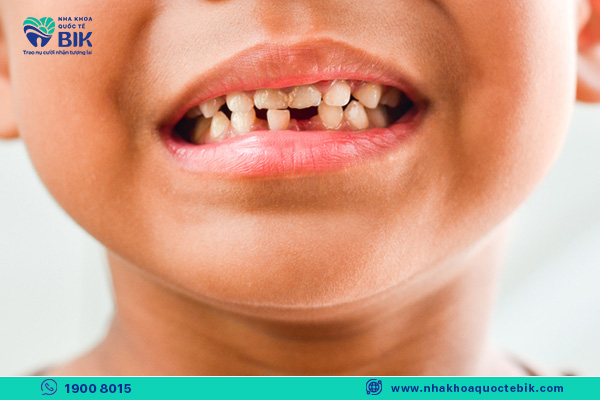hậu quả răng sữa bị sâu là rụng răng sớm