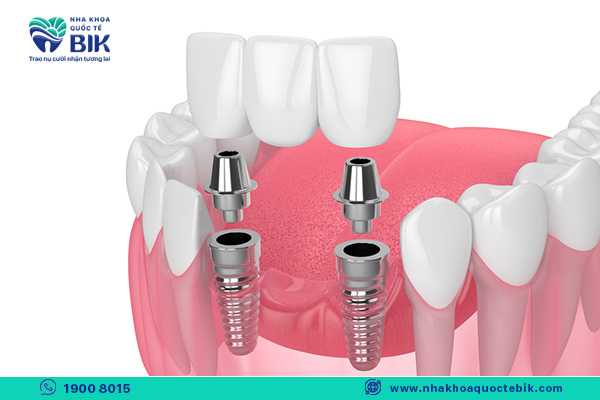 trồng răng implant thay cho hàm tháo lắp