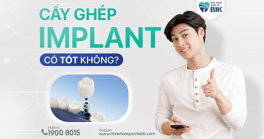 cay-ghep-implant-co-tot-khong