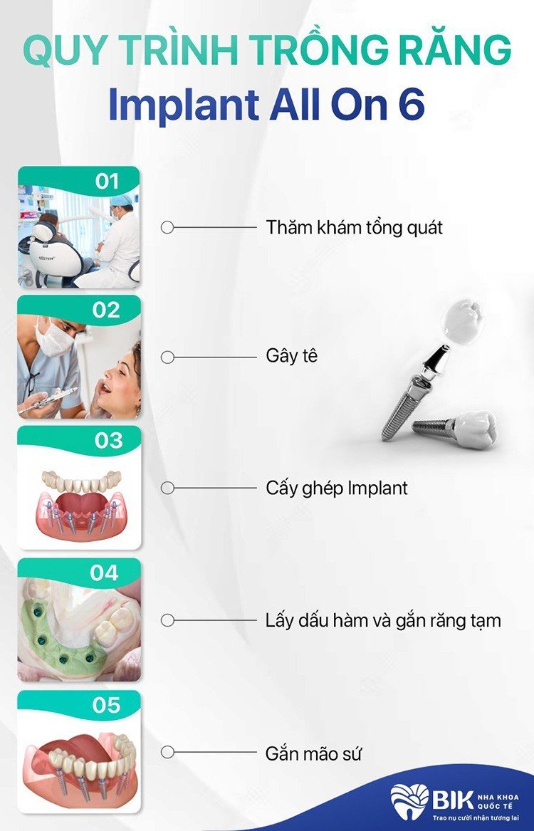 quy-trinh-trong-rang-implant-all-on-6