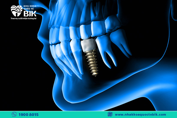 vị trấy trồng răng implant ảnh hưởng mức độ đau