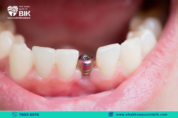 trồng răng implant tồn tại được bao lâu