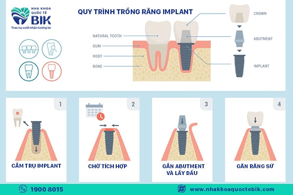 Quy trình thời gian trồng răng implant