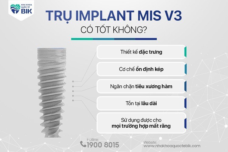tru-implant-mis-v3-co-tot-khong