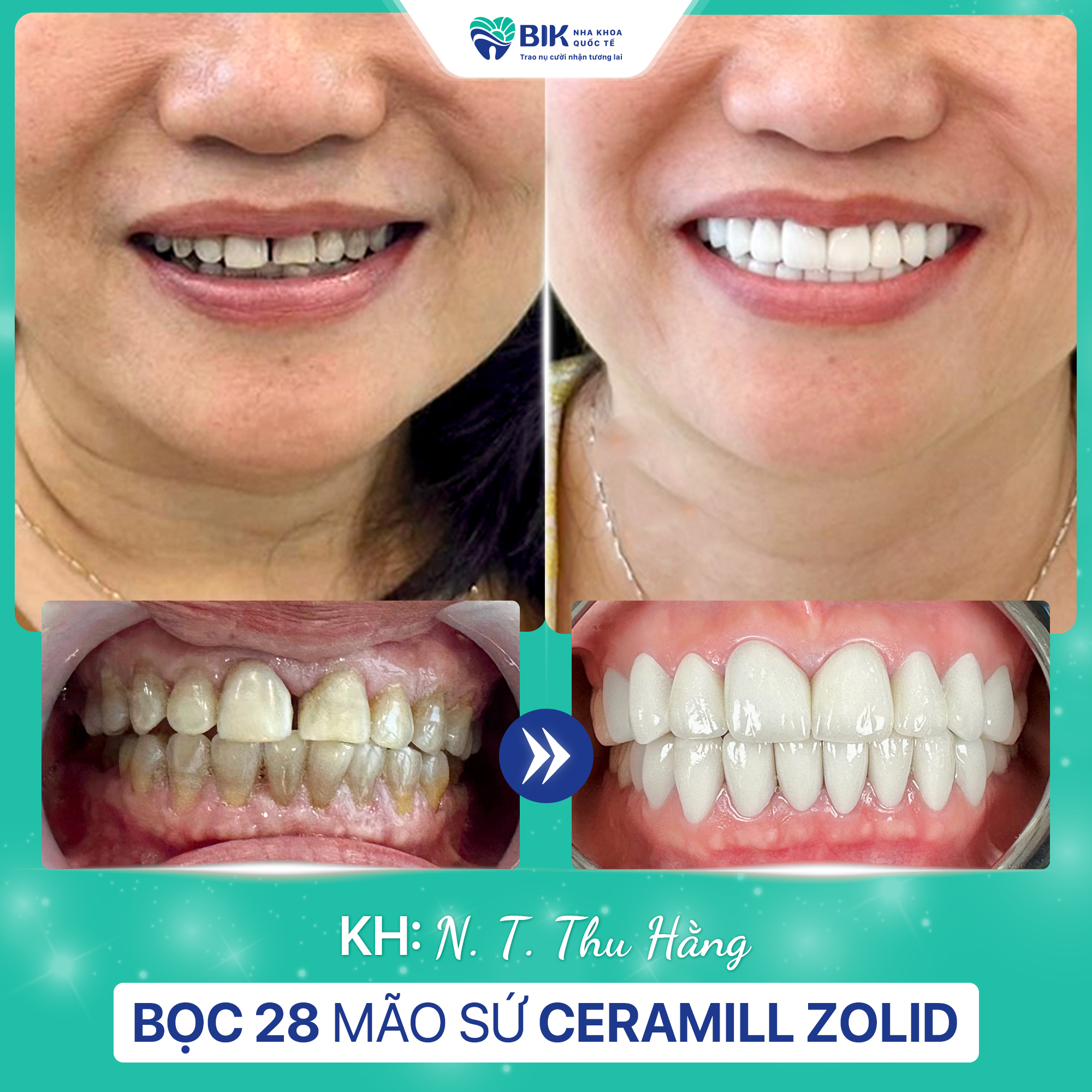 Customers with porcelain crowns at BIK International Dental Clinic