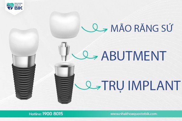 Abutment là gì?