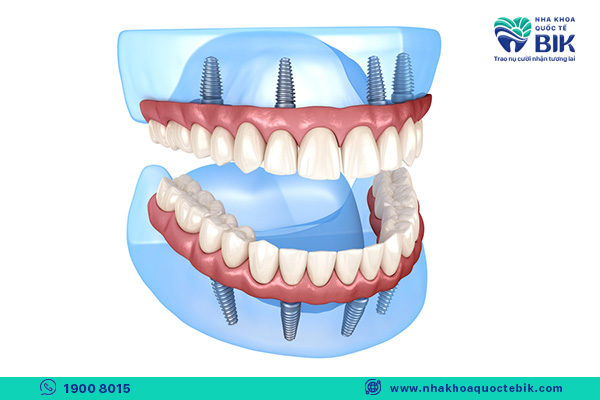 all - on - 4 replaces the entire removable denture