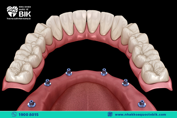 All-on-6 replaces the full-mouth removable denture