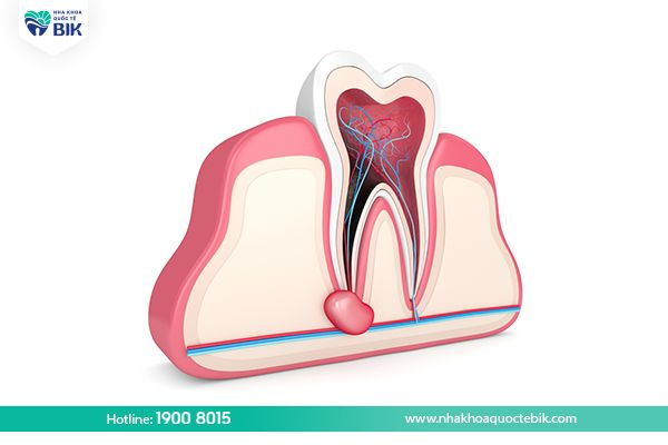 Apical abscess