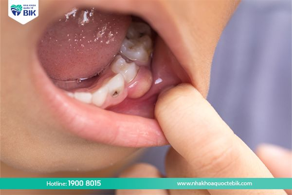 Tooth abscess causes toothache