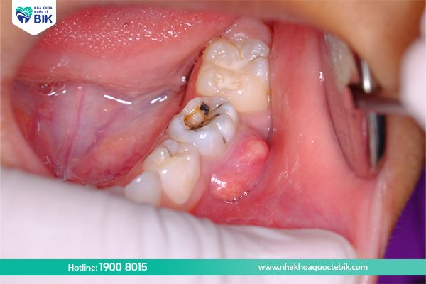 What is a tooth abscess