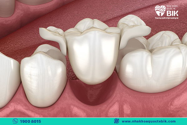 composite porcelain bridge method