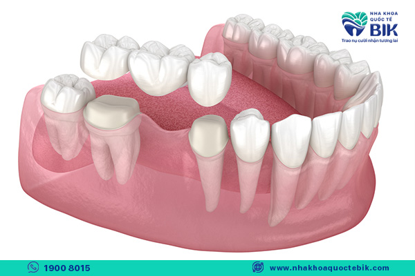 ceramic bridge to replace removable dentures