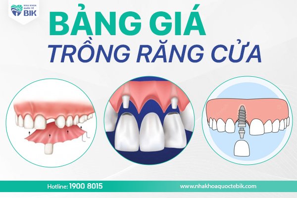 bang-gia-trong-rang-cua