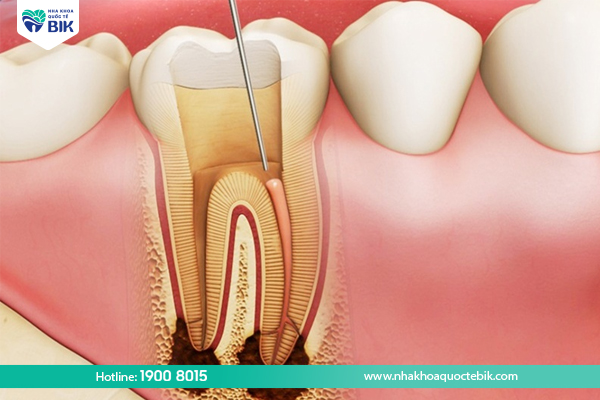 Common diseases of molars