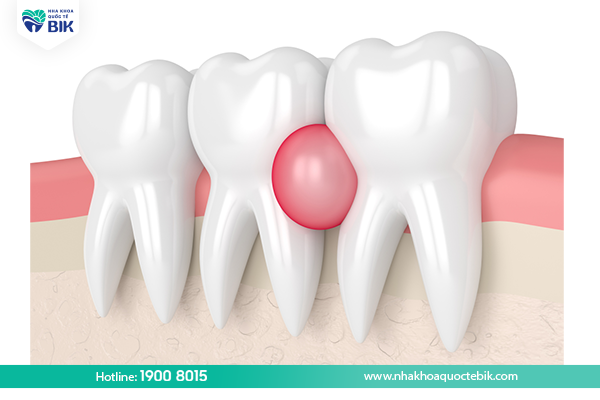 Symptoms of periodontitis